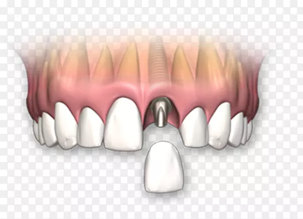 牙种植义齿牙科冠人牙种植体