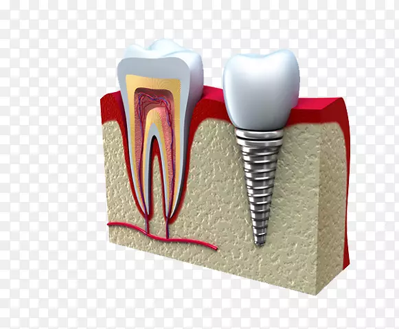 牙科种植体磨牙冠