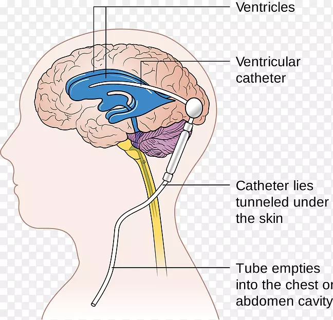 脑分流神经外科脑积水脑脊液脑
