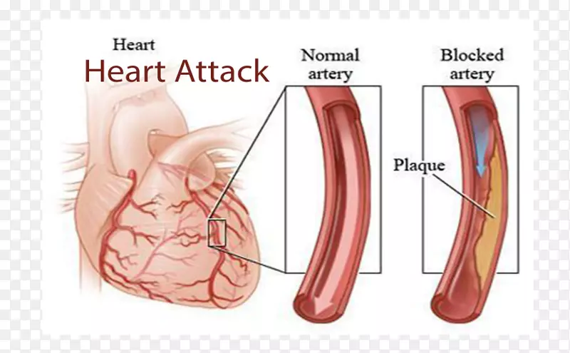 冠状动脉疾病冠状动脉心血管疾病心脏