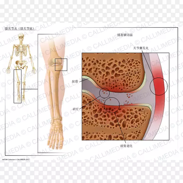 膝关节炎膝骨关节炎-rán 3d
