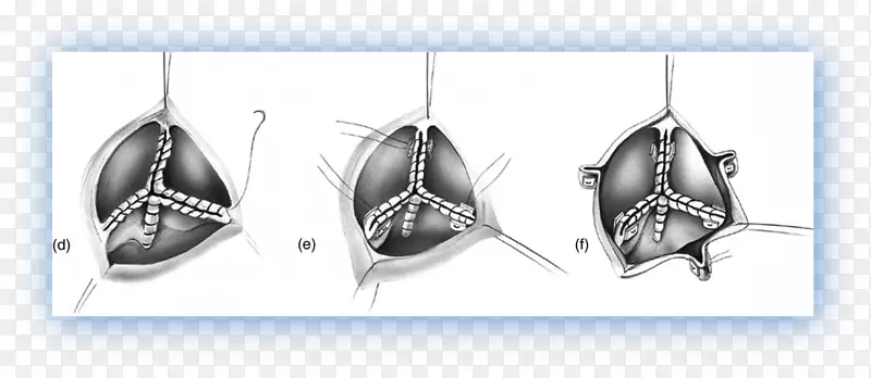 主动脉瓣左冠状动脉-经皮主动脉瓣置换术