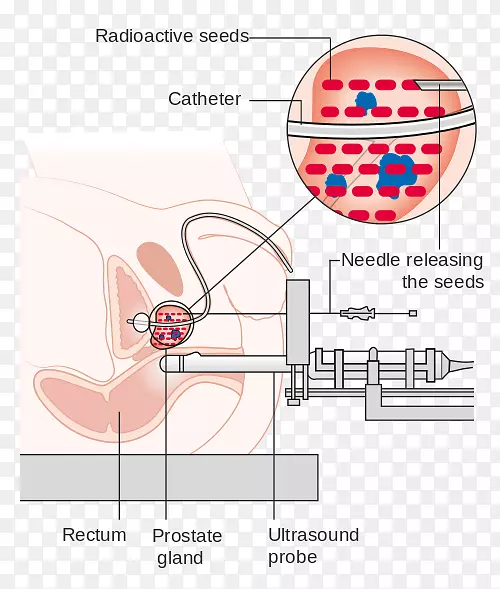 放射治疗前列腺癌近距离治疗质子疗法