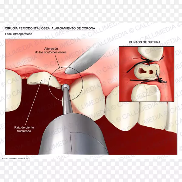 牙冠延长手术牙周病牙冠