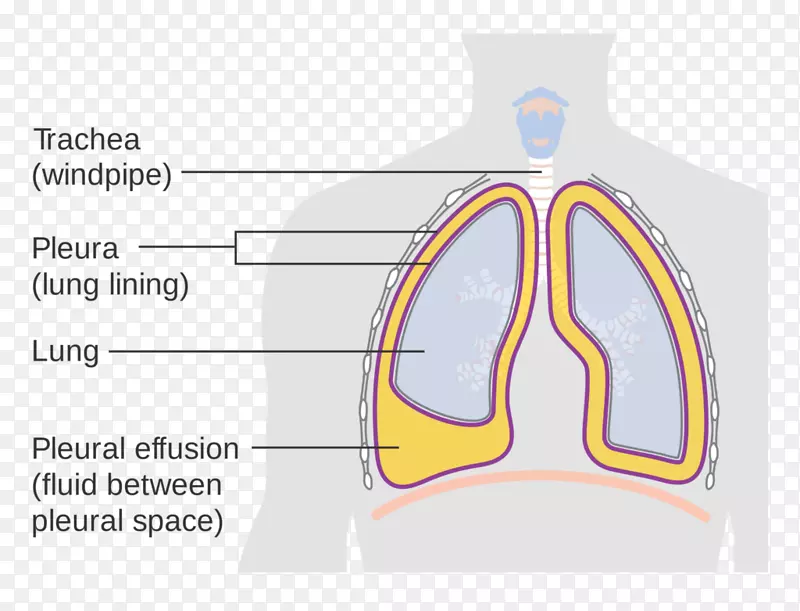 ICD-10胸腔积液肺