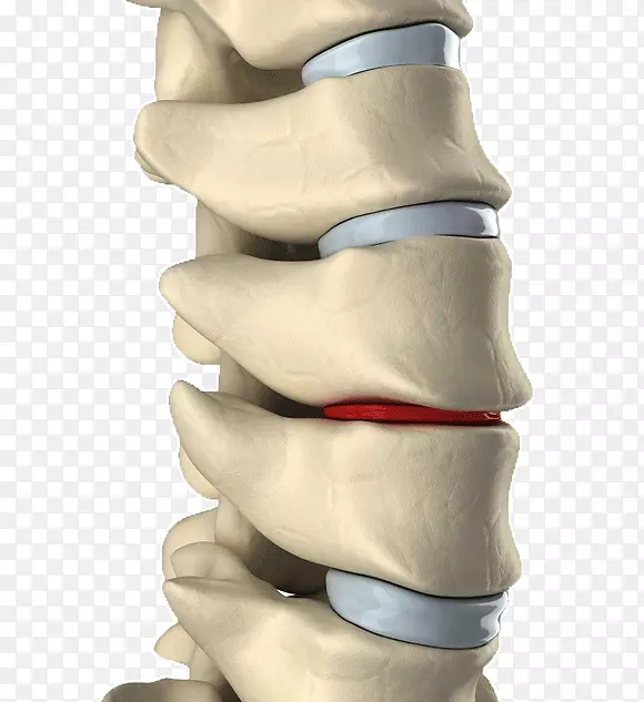 腰椎间盘突出症椎间盘减压背痛脊柱疾病预防