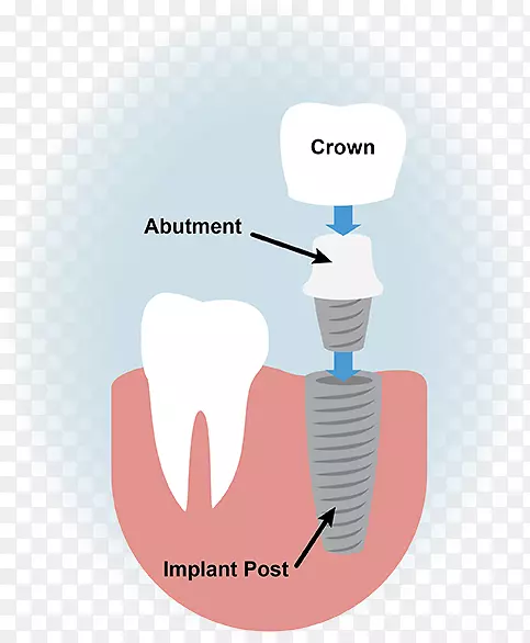 牙科种植体牙科外科.牙科植入物