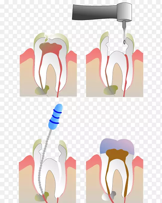 牙髓治疗根管牙科.牙髓