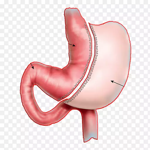 袖状胃切除术胃旁路手术可调胃带减肥手术
