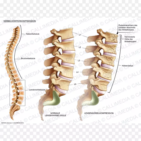 椎体压缩骨折脊柱腰椎骨折