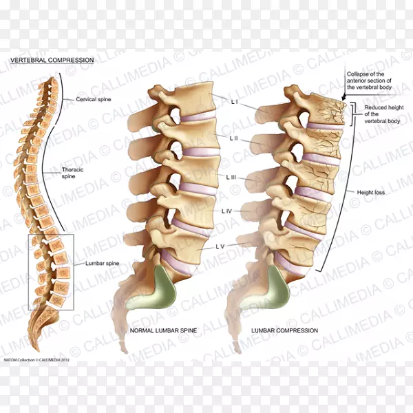椎体压缩骨折脊柱腰椎骨折