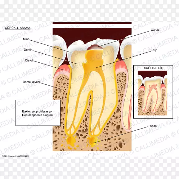 牙脓肿牙刷牙细菌牙