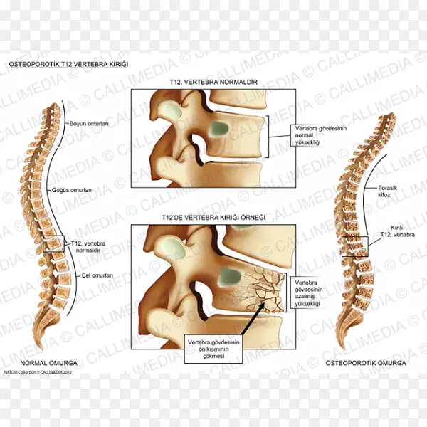 脊柱骨折椎体压缩骨折解剖骨折