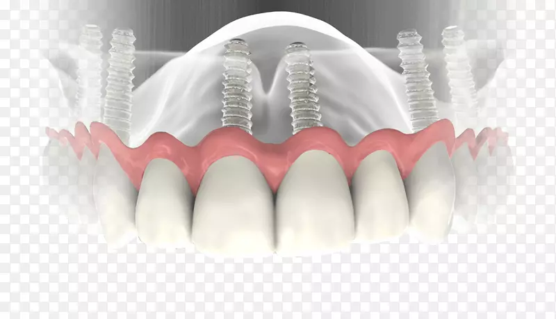 牙科种植义齿.牙科植入物