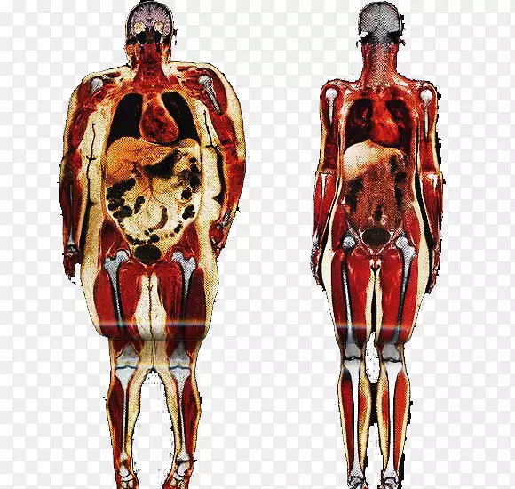 肥胖人体脂肪组织解剖结缔组织-健康