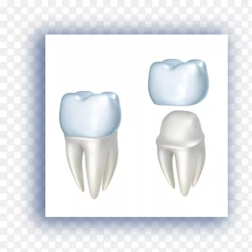 牙科修复牙种植体-受损牙