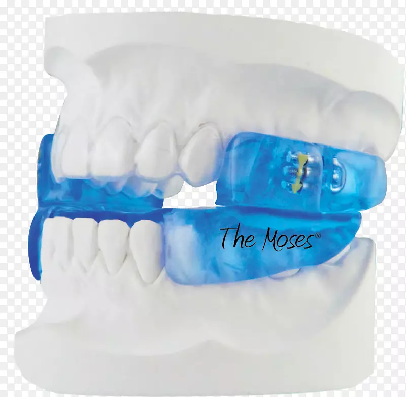 下颌推进夹板阻塞性睡眠呼吸暂停牙医-牙科结构及治疗
