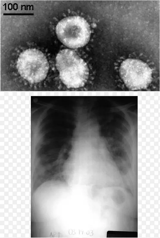 中东呼吸综合征冠状病毒严重急性呼吸综合征冠状病毒科-肺炎病理生理学