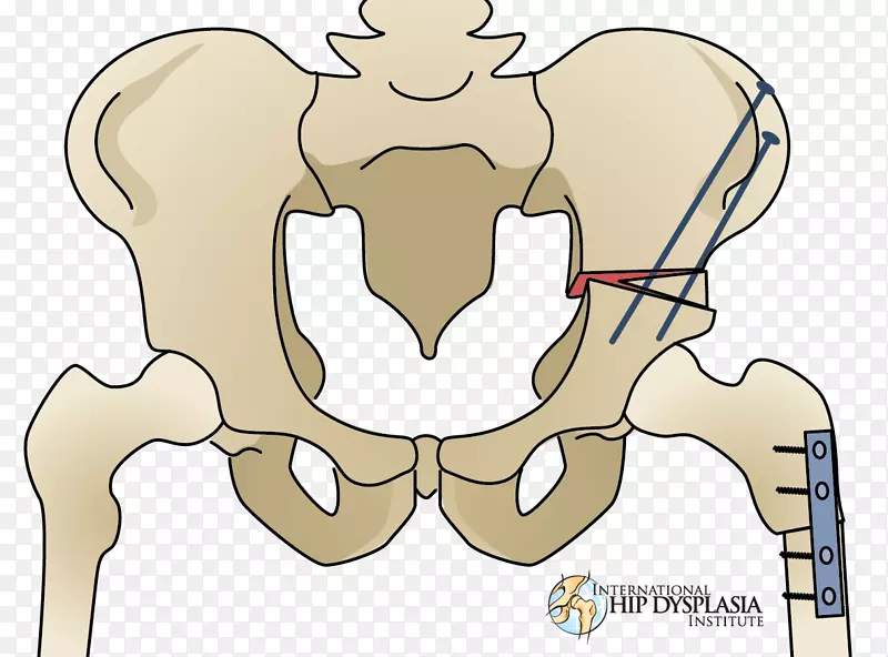 截骨术髋关节发育不良手术治疗-环磷酰胺