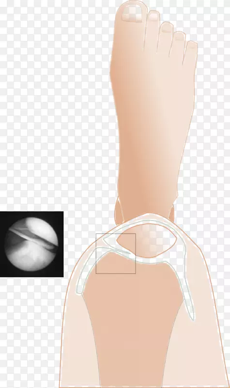 拇指皱襞综合征膝关节疼痛髌骨弹性