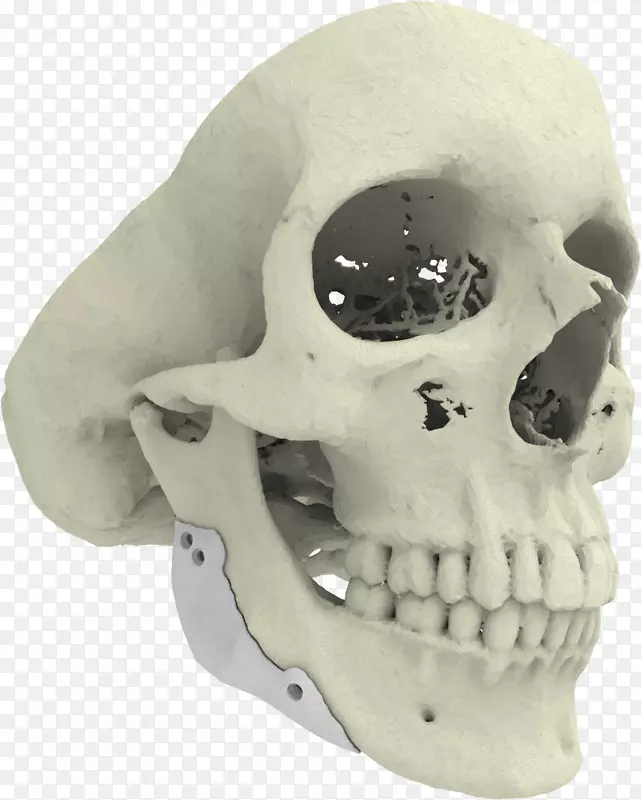 三维打印种植体X骤c骨三维打印下颌骨