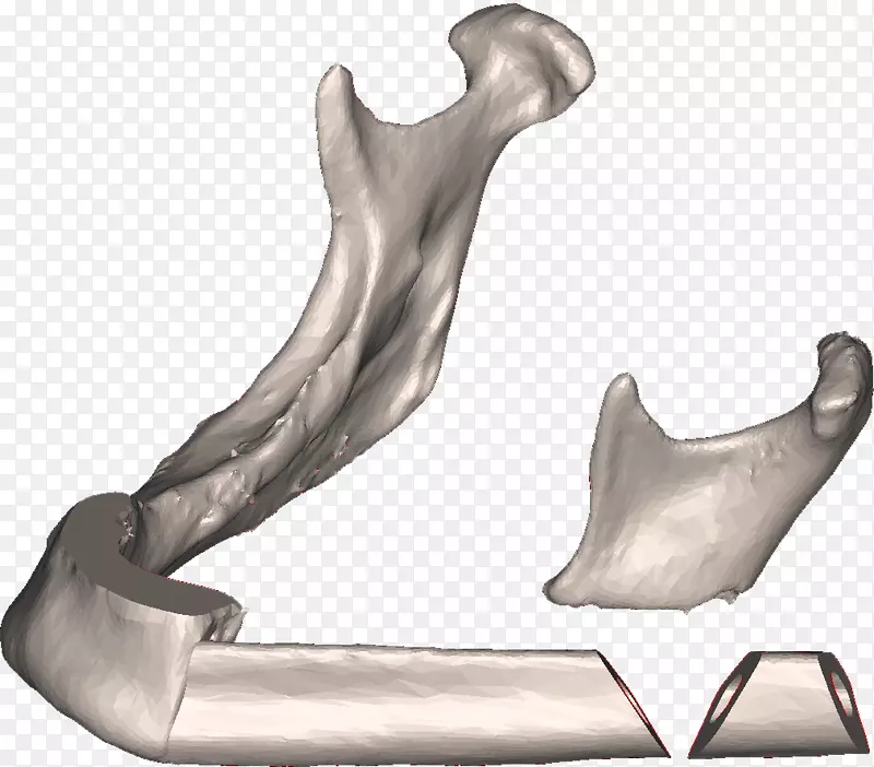 腓骨手术下颌骨截骨-下颌骨推进夹板