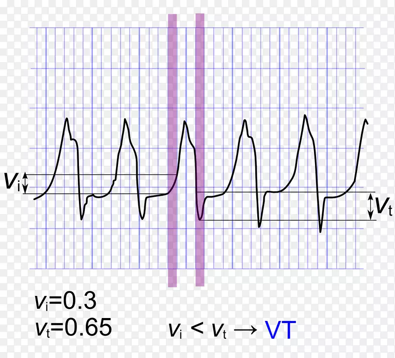 QRS复合室性心动过速算法束支传导阻滞心电图