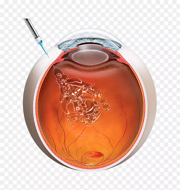 玻璃体内注射黄斑变性注射贝伐单抗血管内皮生长因子治疗眼
