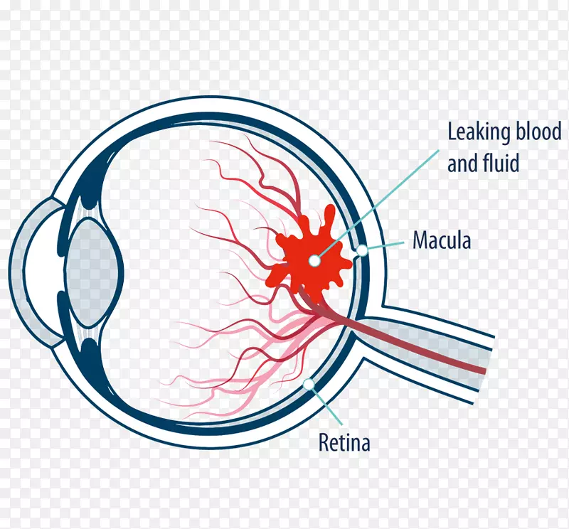黄斑部视网膜黄斑水肿糖尿病视网膜病变眼-眼