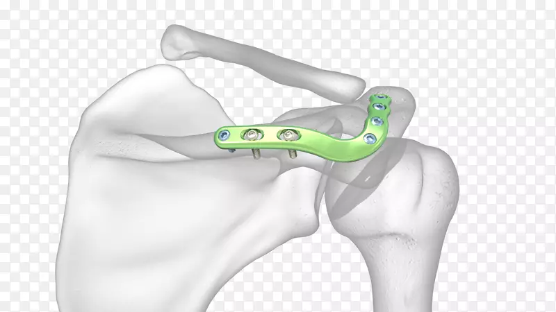 拇指肩峰肩关节肩胛骨折的定义