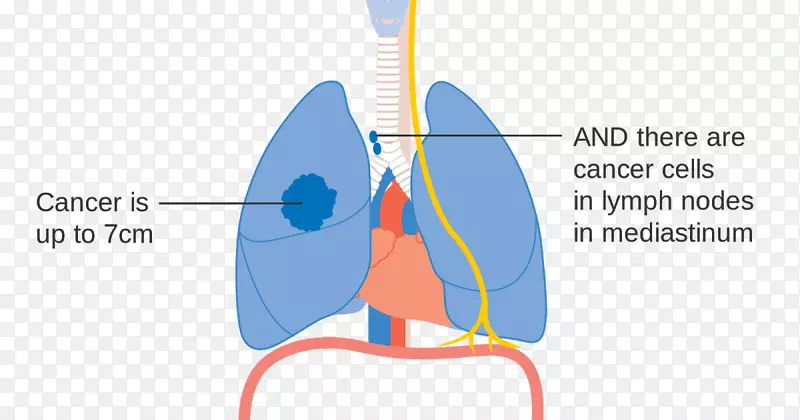 肺癌分期-人肺