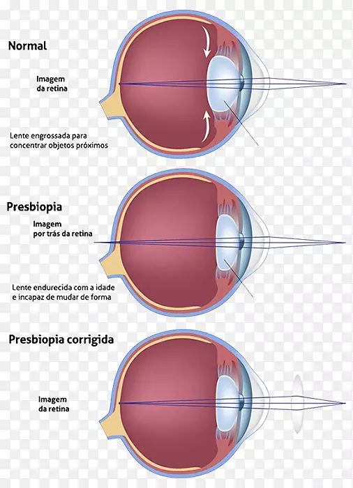 老视进行性晶状体眼科近视眼-临床