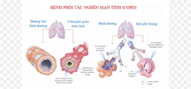 再生医学干细胞慢性阻塞性肺疾病干细胞治疗-慢性疾病