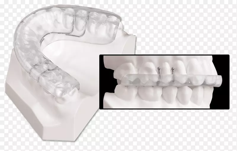 颌骨夹板、上颌牙科学、颞下颌关节功能障碍-下颌推进夹板
