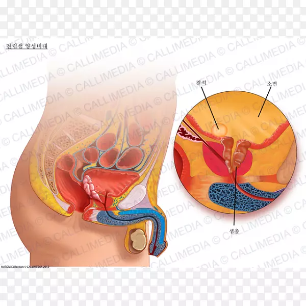 前列腺泌尿系统良性前列腺增生膀胱泌尿外科-前列腺