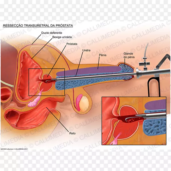 经尿道前列腺电切术