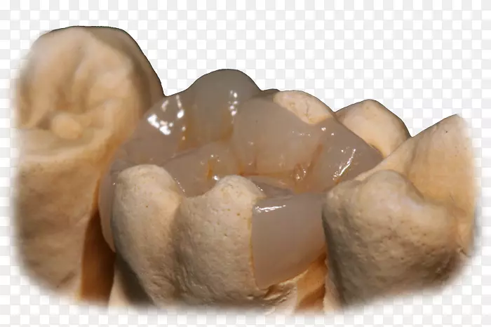 冠状cad/凸轮牙科镶嵌和镶嵌桥滑块图像