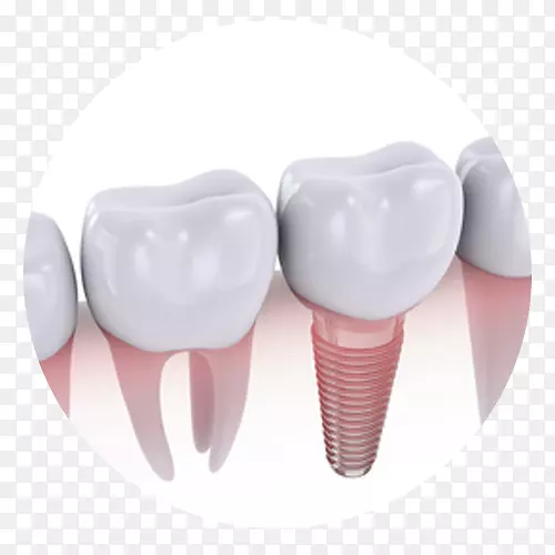 牙种植体牙科义齿冠牙种植体