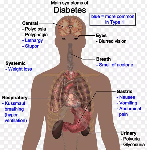 糖尿病2型疾病人体1型糖尿病-根据DR。
