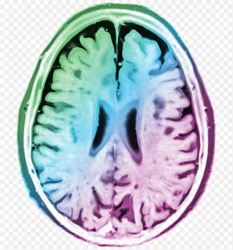 脑组织计算机断层扫描-心灵的平静