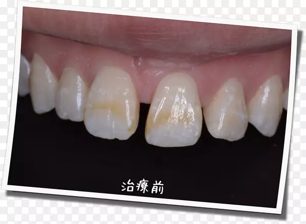 脱灰蛀牙牙釉质疗法-牙科明信片