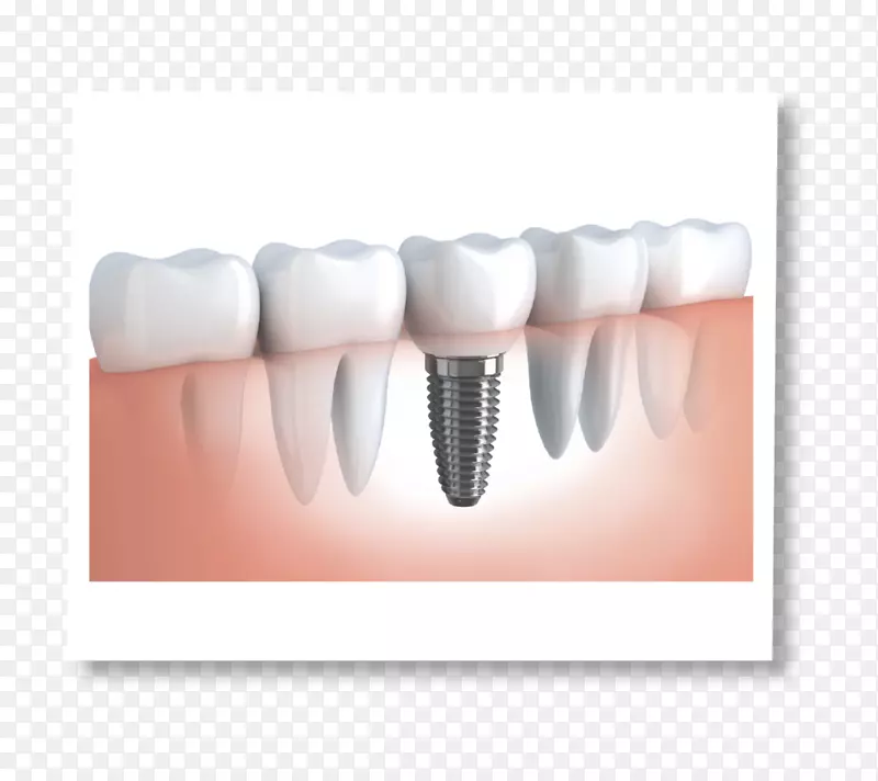 牙科种植义齿.牙冠