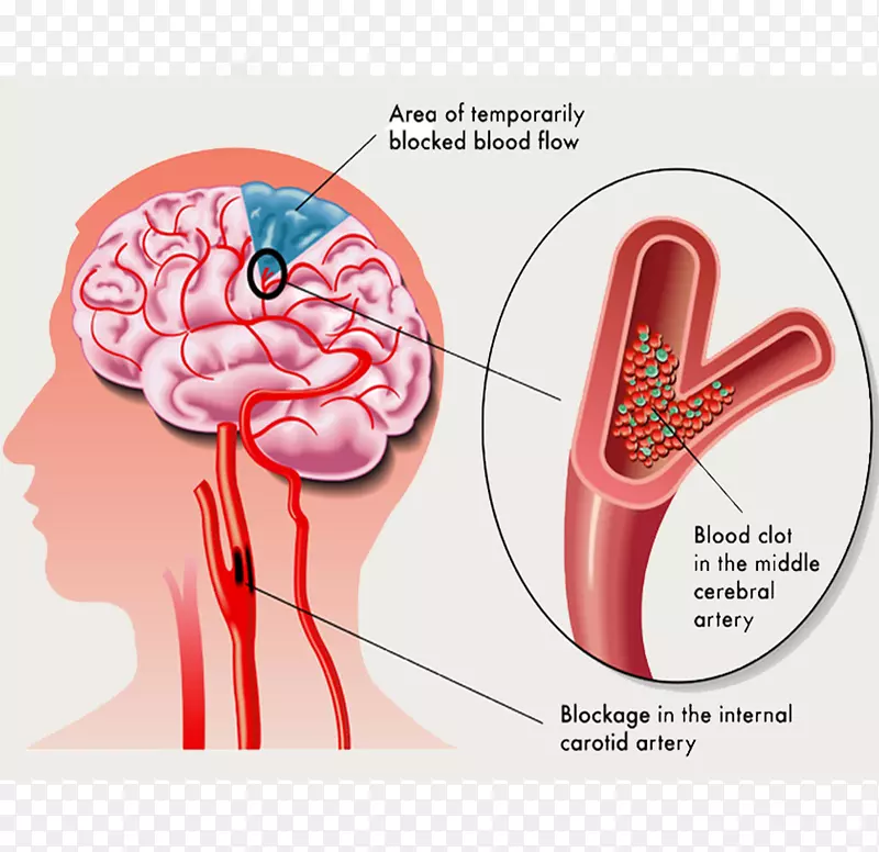 短暂性缺血发作缺血性中风缺血症状-脑