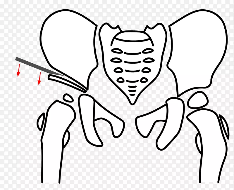 骨盆三联截骨术髋臼骨盆发育不良