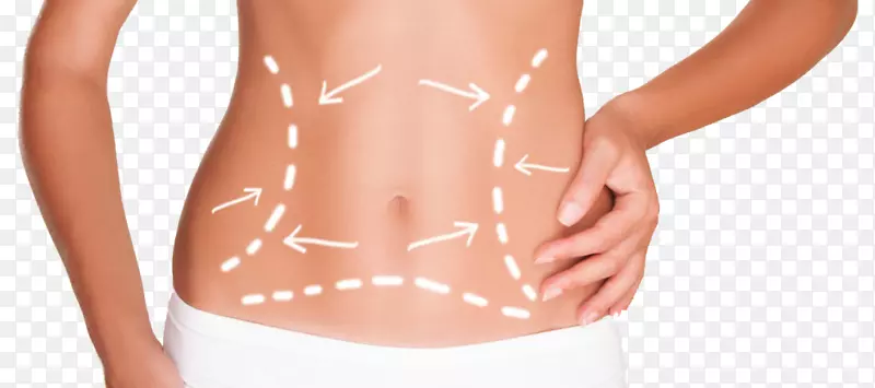 腹部脂肪组织体轮廓冷冻脂肪腹壁成形术-身体轮廓