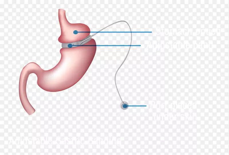 减肥手术可调胃带胃旁路手术袖状胃切除术-胃