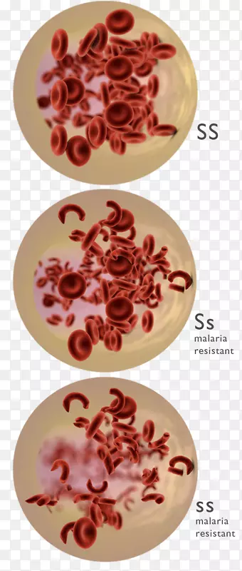 共显性镰状细胞病遗传障碍遗传学红细胞溶解