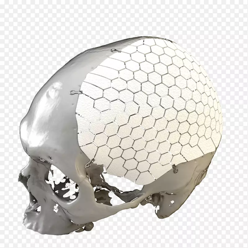 种植体3D打印ossdsignab手术.三维打印下颌骨