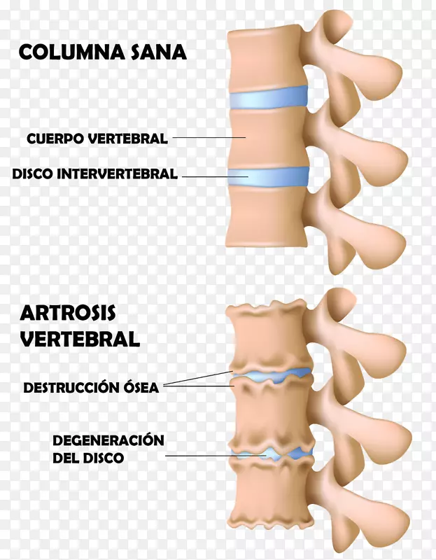 脊柱骨赘骨关节炎骨性退行性椎间盘疾病颈椎病