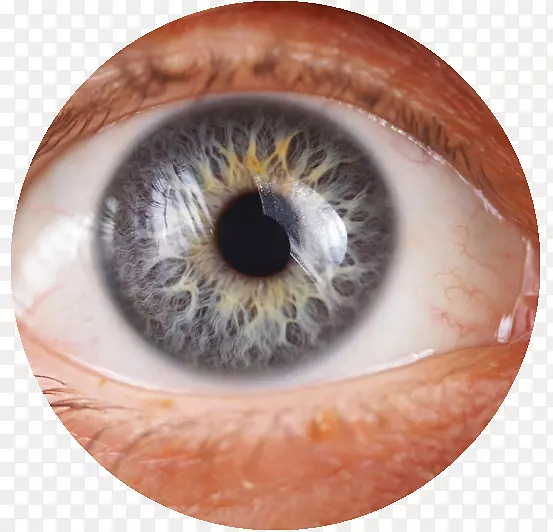 青光眼虹膜健康治疗-眼